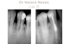 Cas cliniques Endodontie