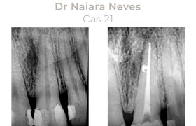 Cas cliniques Endodontie