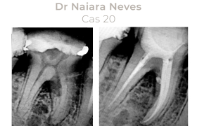 Cas cliniques Endodontie