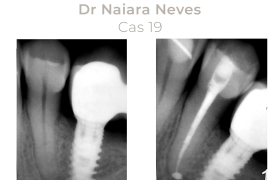 Cas cliniques Endodontie