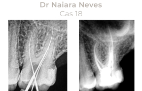 Cas cliniques Endodontie