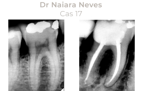 Cas cliniques Endodontie