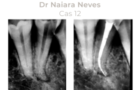 Cas cliniques Endodontie