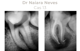 Cas cliniques Endodontie