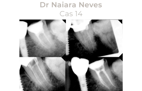 Cas cliniques Endodontie