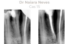 Cas cliniques Endodontie