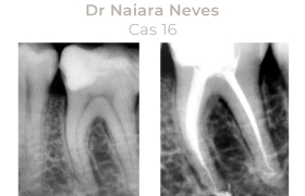 Cas cliniques Endodontie