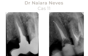 Cas cliniques Endodontie