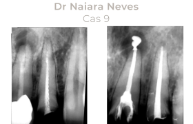 Cas cliniques Endodontie