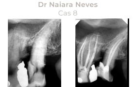 Cas cliniques Endodontie