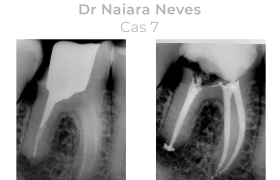 Cas cliniques Endodontie