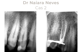 Cas cliniques Endodontie