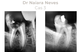 Cas cliniques Endodontie