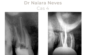 Cas cliniques Endodontie