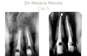 Cas cliniques Endodontie