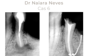 Cas cliniques Endodontie