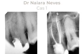 Cas cliniques Endodontie