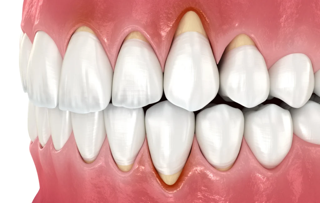 greffes gencive soin dentaire Soins chirurgicaux des gencives Mediweb - Template 5