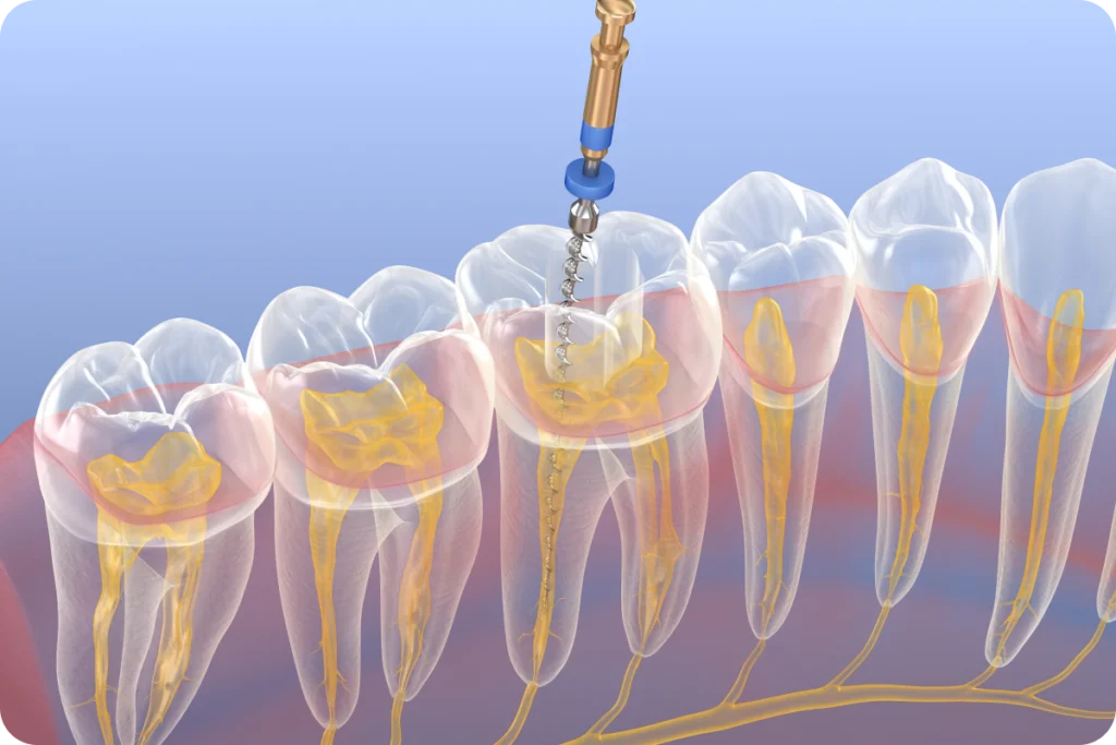 Consultation d’endodontie