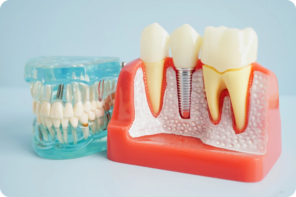 Consultation pour un implant dentaire à Saint-Cyr-sur-Mer