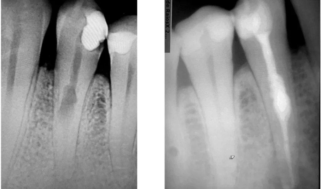 Soulager une douleur par l’endodontie à Saint-Cyr-sur-Mer