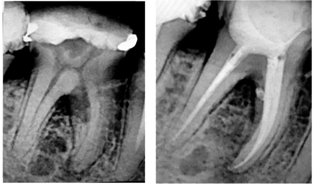 Endodontie : douleur dentaire à Saint-Cyr-sur-Mer