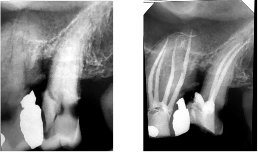 Infection d’une racine dentaire