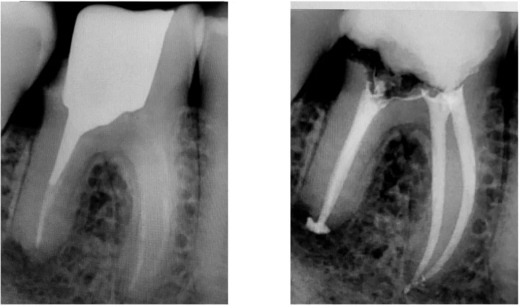 Microchirurgie endodontique à Saint-Cyr-sur-Mer