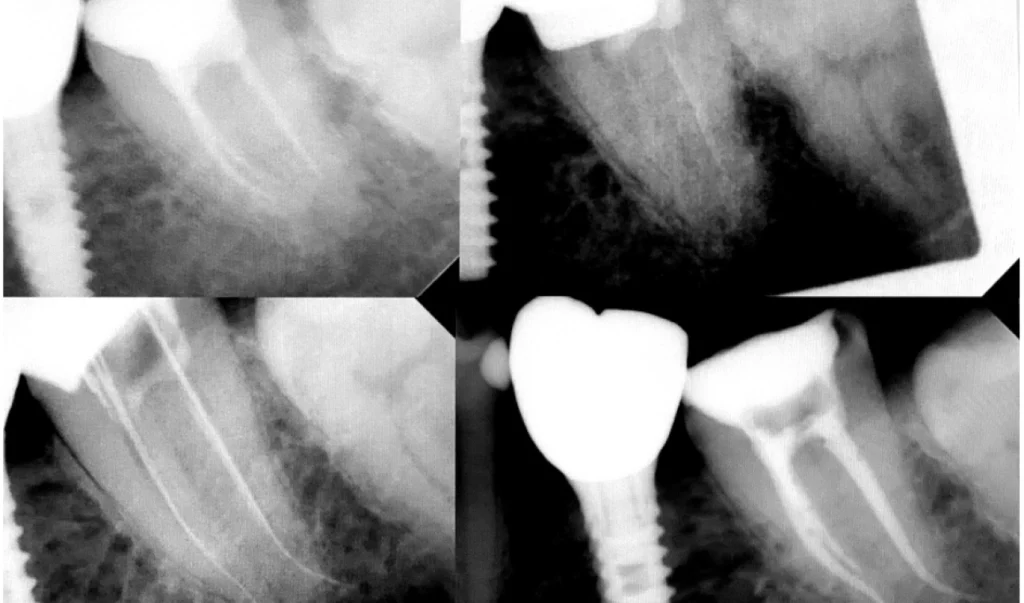 Endodontie des racines dentaires à Saint-Cyr-sur-Mer