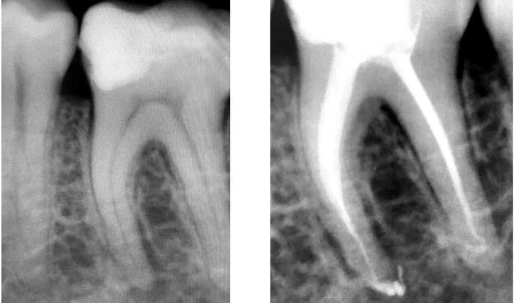 Racines dentaires traitées en endodontie à Saint-Cyr-sur-Mer