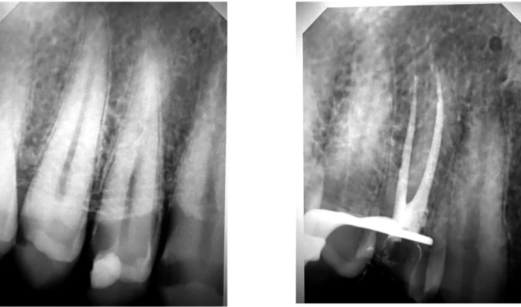 Résection apicale en endodontie à Saint-Cyr-sur-Mer
