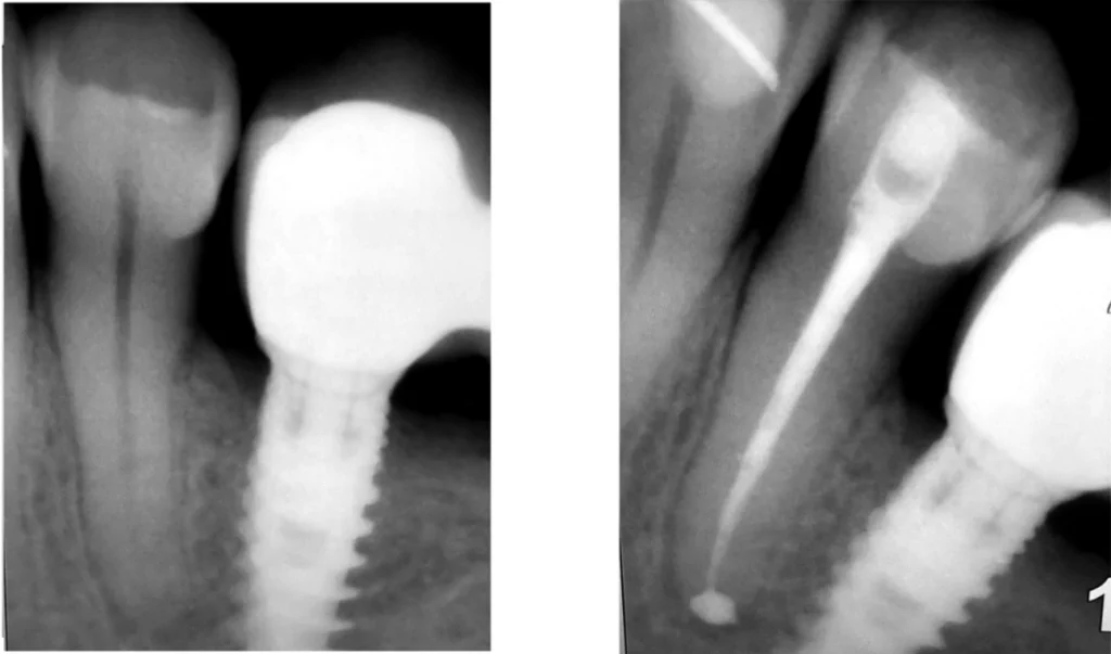 Nouvelle endodontie sur une dent traitée