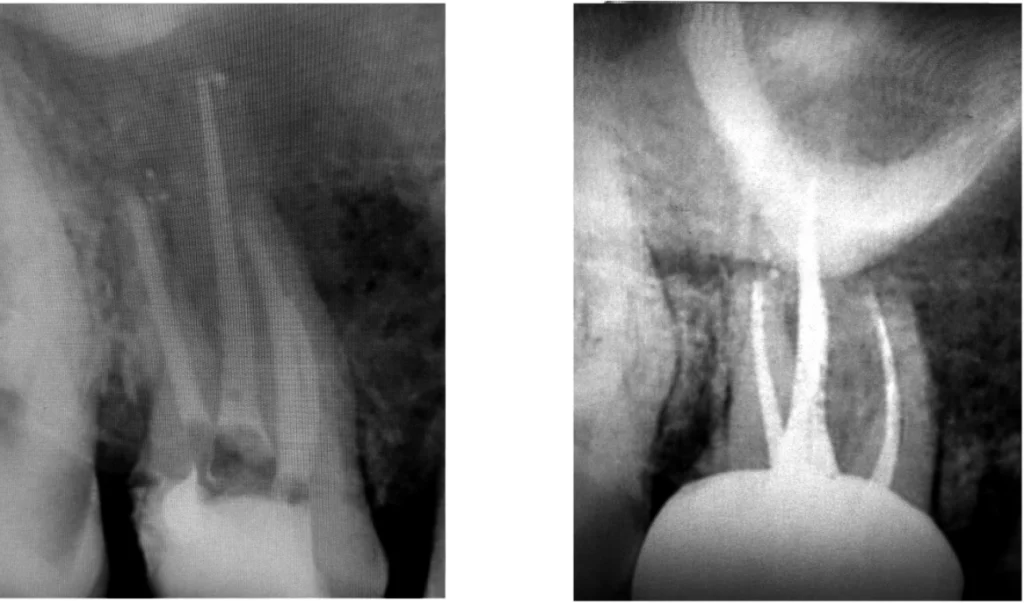 Sauvetage d’une dent par endodontie