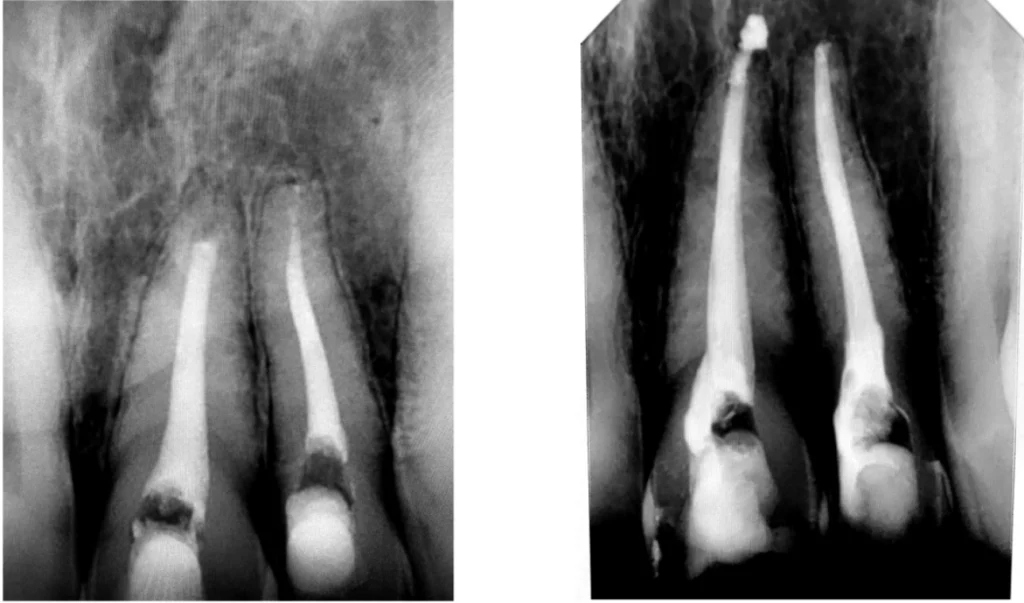 Traitement de canal (endodontie)