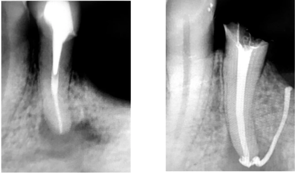 Endodontie en urgence dentaire à Saint-Cyr-sur-Mer